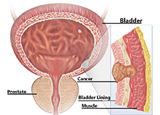 Bladder Cancer Treatment India