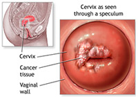 Cervical Cancer Treatment India