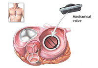 Heart Valve Replacement Surgery India