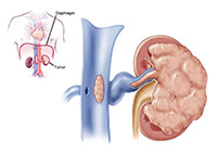 Kidney Cancer Treatment India