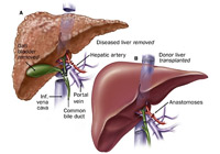 Liver Transplant Surgery India