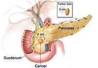 Pancreatic Cancer Treatment India