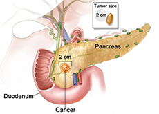 Pancreatic Cancer Treatment India