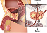 Prostate Cancer Treatment India