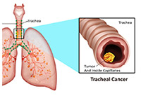 Tracheal Cancer Treatment India