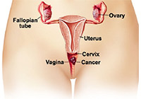 Vaginal Cancer Treatment India