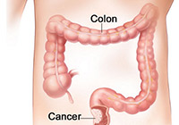 Colon Cancer Treatment India