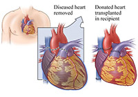 heart transplant surgery india