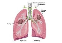 Lung Cancer Treatment India