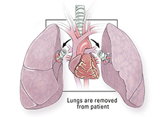 Lung Transplant Surgery India