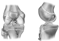 ACL Reconstruction Surgery India