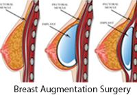 Breast Augmentation Surgery India