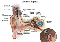 Cochlear Implant Surgery India