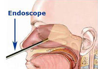 Endoscopic Sinus Surgery India