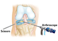 Knee Arthroscopy Surgery India