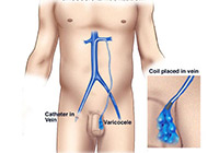 Laparoscopic Varicocelectomy India