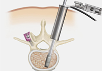 Minimally Invasive Spine Surgery India