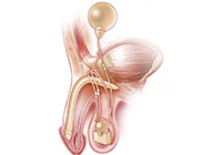 Penile Implant Surgery India