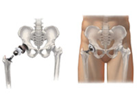 Revision of Hip Replacement Surgery India