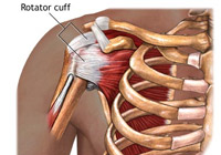 Rotator Cuff Repair Surgery India
