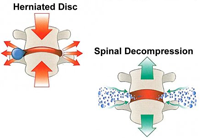 Spinal Decompression Surgery India