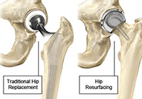 Total Hip Resurfacing Surgery India