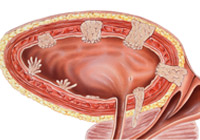 Transurethral Resection Of Bladder Tumor (TURBT) Treatment India