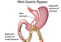Laparoscopic Minigastric Bypass Surgery India