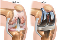 Total Knee Replacement Surgery India