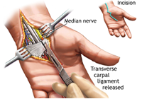 Carpal Tunnel Release Surgery India