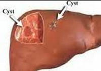 Laparoscopic Liver Cysts Surgery India