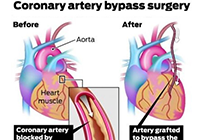 Minimally Invasive Heart Bypass Surgery India