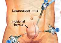 Laparoscopic Hernia Surgery India