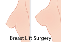 Breast Lift Surgery India