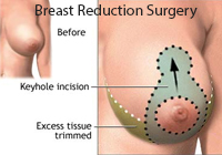 Breast Reduction Surgery India