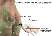 Liposuction Procedure India