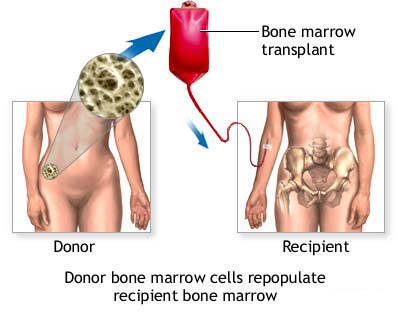 bone marrow transplant in India
