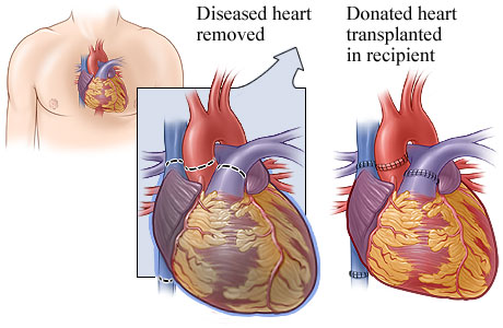 heart transplant surgery in india