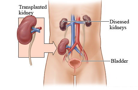 kidney transplant surgery in india