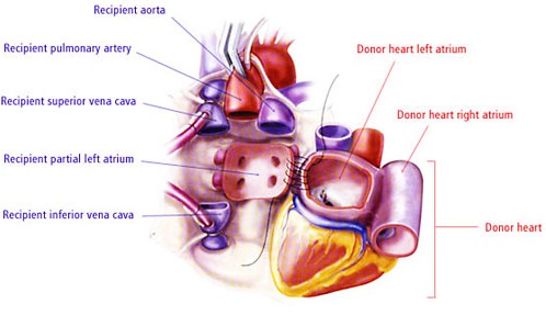 Heart Transplant Surgery in India